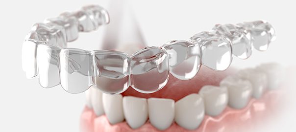 Transparent Invisalign clear aligners being used for orthodontic treatment at a dental clinic in Narre Warren Australia