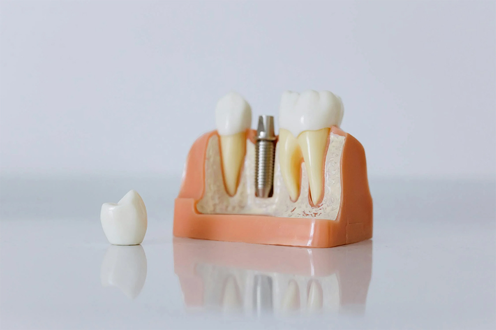 A dentist holding dental implants at Victor Crescent Dental Clinic in Narre Warren, offering permanent and natural-looking solutions for missing teeth with advanced implant technology.