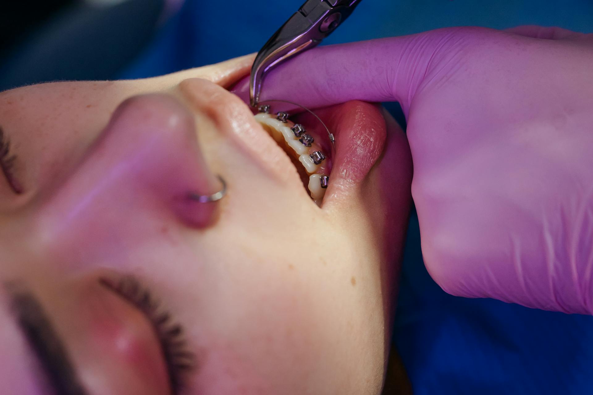 A dentist performing a braces wiring procedure on a patient at Victor Crescent Dental Clinic in Narre Warren, providing expert orthodontic care for straighter, healthier smiles.